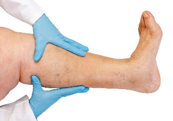 NanoVein used in the treatment of varicose veins, thrombosis, related diseases