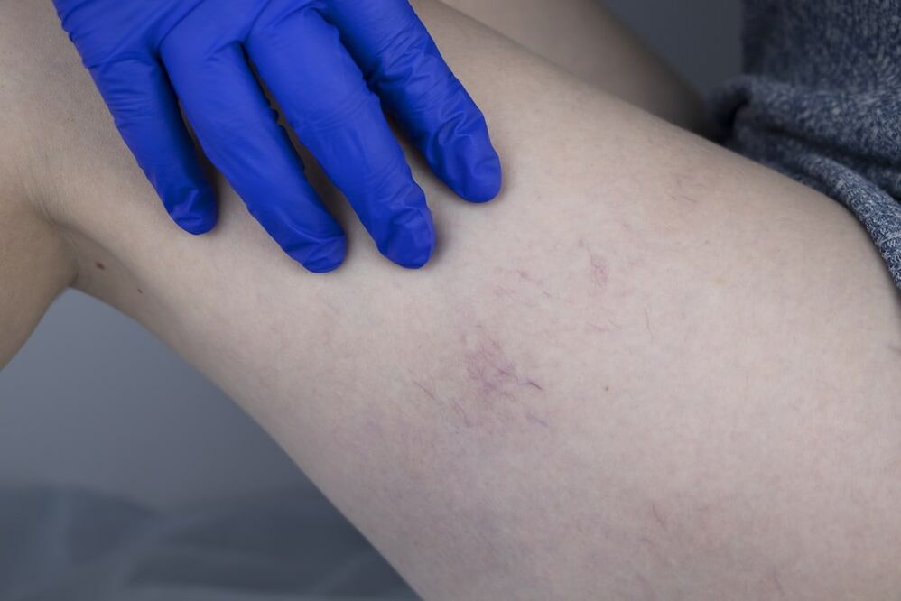 Signs of retriminated varicose veins