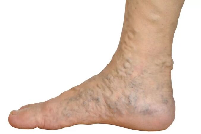 The diseases of vegete's legs