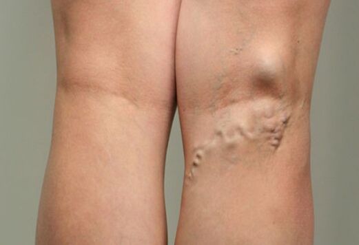 Vascular disease