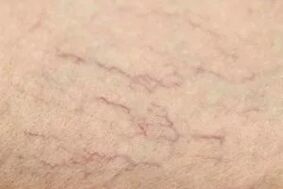 Vascular stars