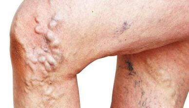 Main manifestations of varicose veins in the legs