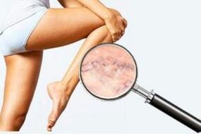 vein damage - light varicose veins
