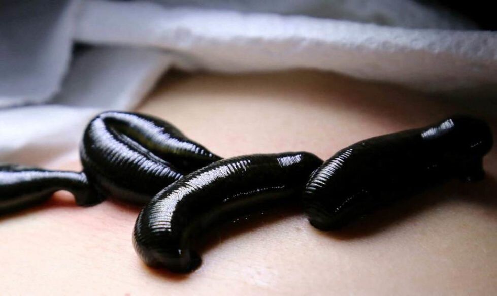 Treatment of varicose veins with leech