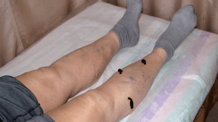 treatment of varicose veins with leech