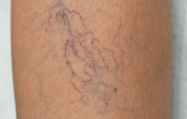 Varicose veins on legs in women