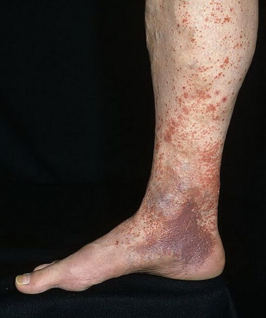 Varicose dermatiti