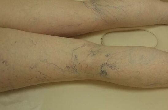 Varicosis stars in the legs