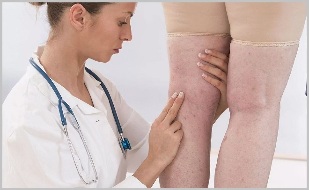 A woman with obvious signs of varicose veins went to the doctor