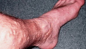 Causes of varicose veins in the legs in men