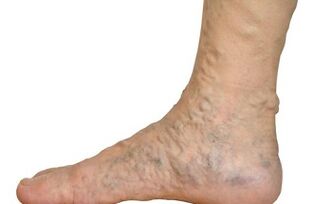 Forms of varicose veins