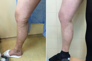 laser treatment of varicose veins before and after images