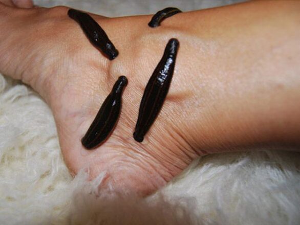 Treatment of varicose veins of the legs with leech
