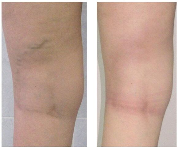 Veins in the leg before and after varicose veins