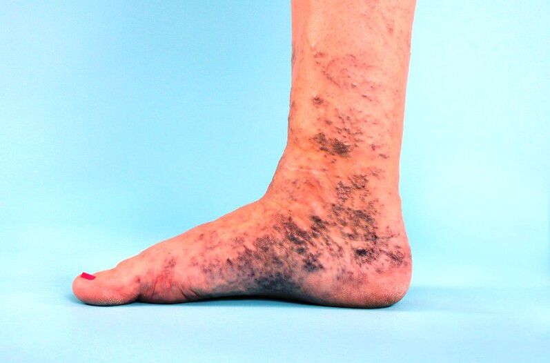 varicose veins in the leg are ignored