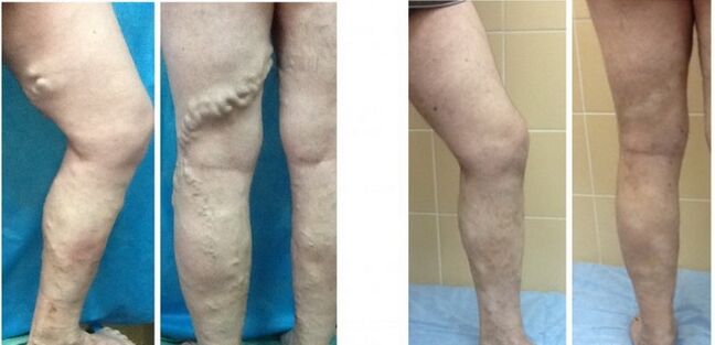 Legs before and after radiofrequency obliteration in varicose veins