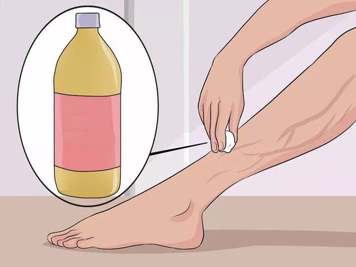 How to rub apple cider vinegar on the affected areas