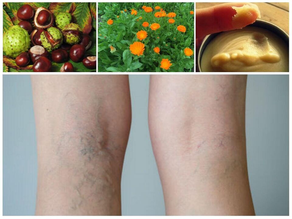 Folk remedies for varicose veins in the legs and its prevention
