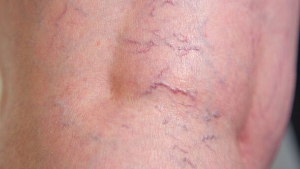 Symptoms of reticular varicose veins of the lower extremities - dilation of small vessels and vascular networks