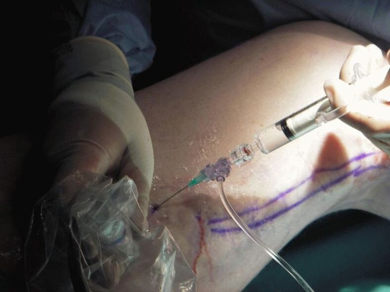 Sclerotherapy as a method for the treatment of varicose veins