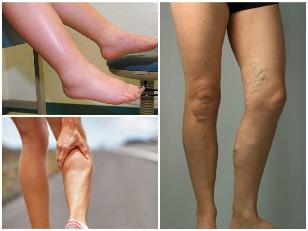 the effects of varicose veins